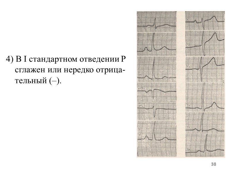 38 4) В I стандартном отведении Р сглажен или 38 4) В I стандартном отведении Р сглажен или